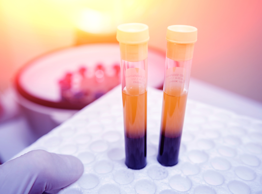 Platelet Rich Plasma (PRP)